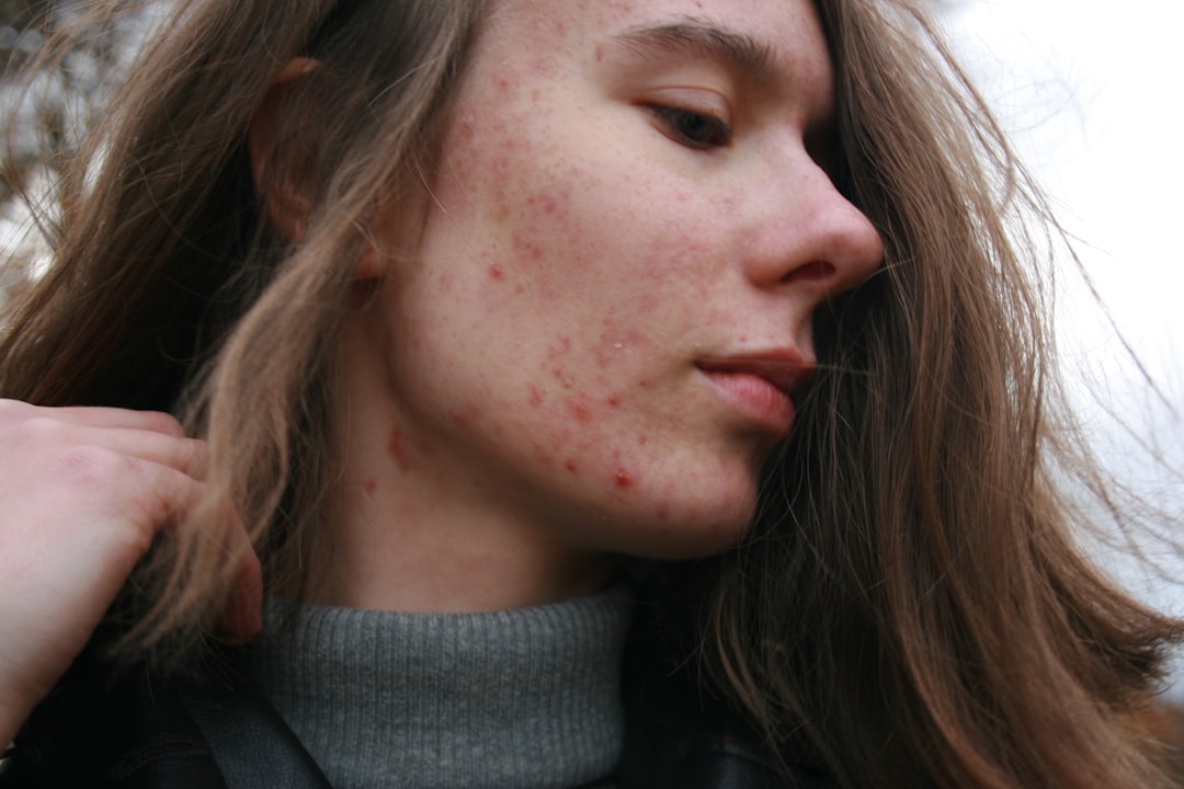 Esthetician consulting with a client about a personalized acne treatment plan