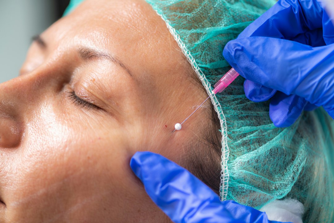 Clinical dermatology treatment being performed on a patient's face for acne scarring
